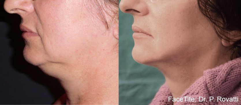 Before and After FaceTite Treatment