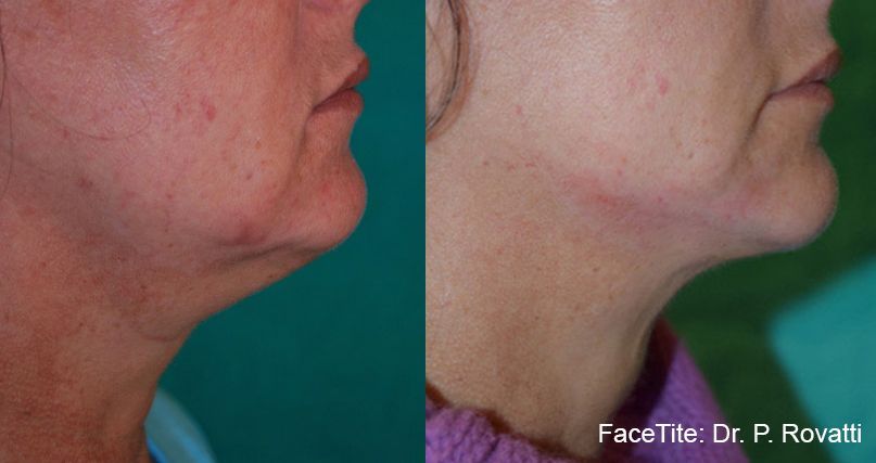 Before and After FaceTite Treatment