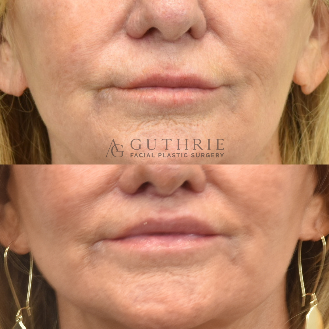 guthrie facial plastic surgery patient before and after lip lift