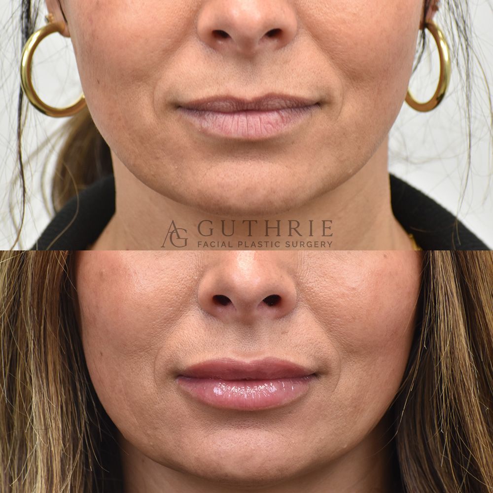 Before and After Lip Fillers