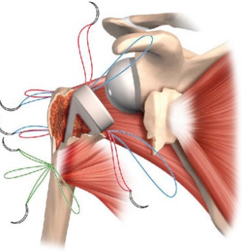 Traditional Approach | AZ Ortho Traditional Approach | AZ Ortho