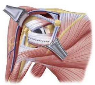 Sparing Approach 1 | AZ Ortho Sparing Approach 1 | AZ Ortho