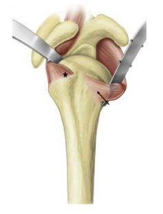 Sparing Approach 2 | AZ Ortho Sparing Approach 2 | AZ Ortho
