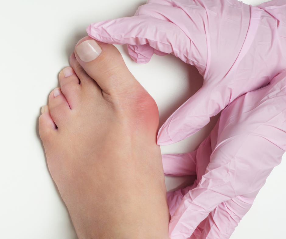 Bunions | AZ ORTHO Bunions | AZ ORTHO