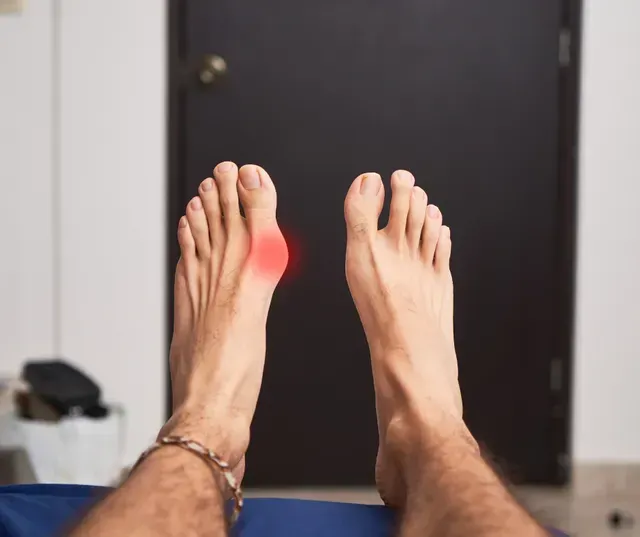 Bunions