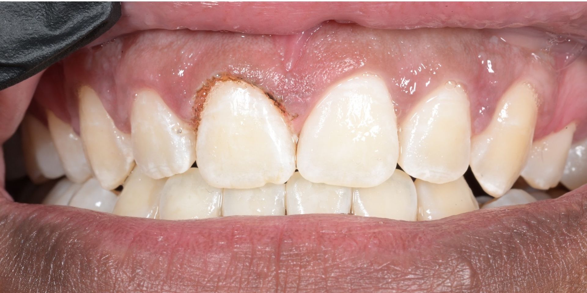 Close-up of human teeth, showing a possible dental issue like gum inflammation and/or a cavity.