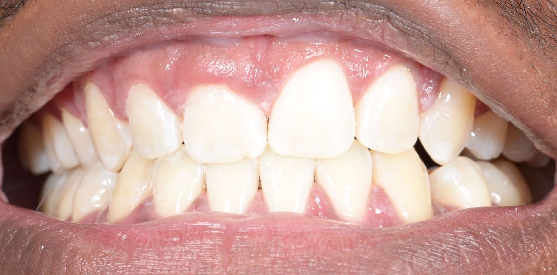 Close-up of a person's teeth. They are white and slightly yellowed, with visible gums.