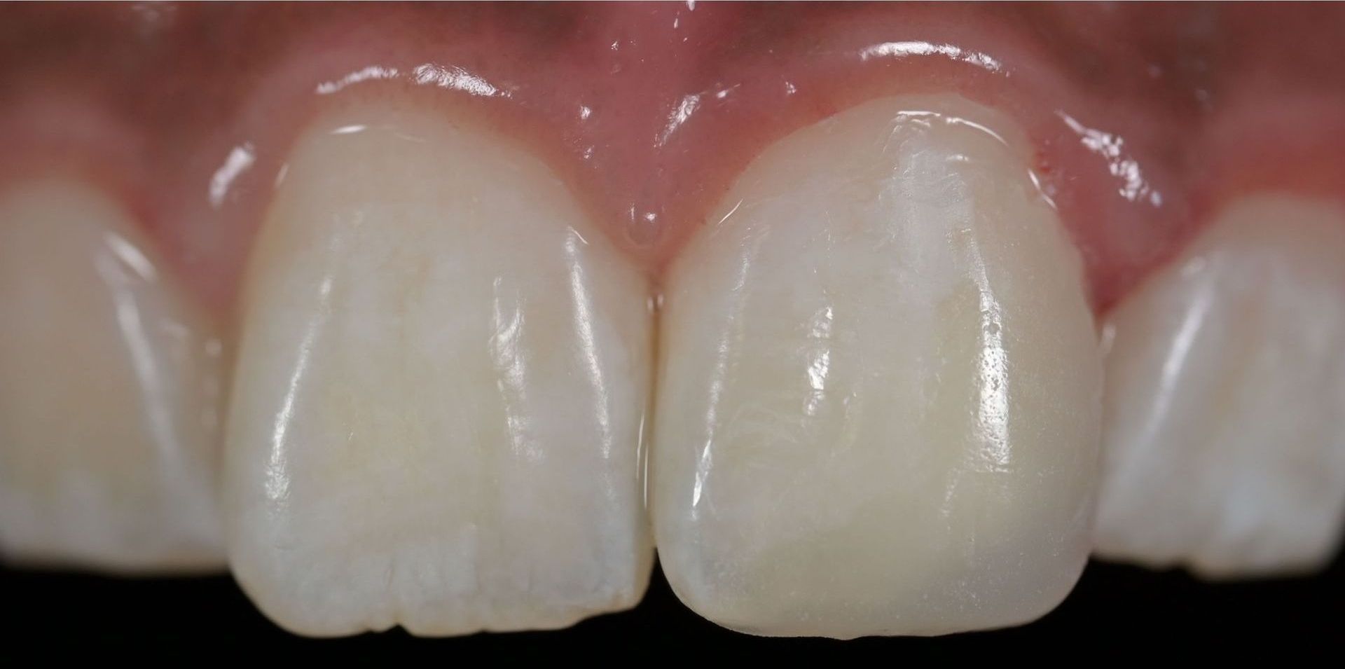 Close-up of two front teeth; teeth are white with a slight gloss, pink gums are visible.
