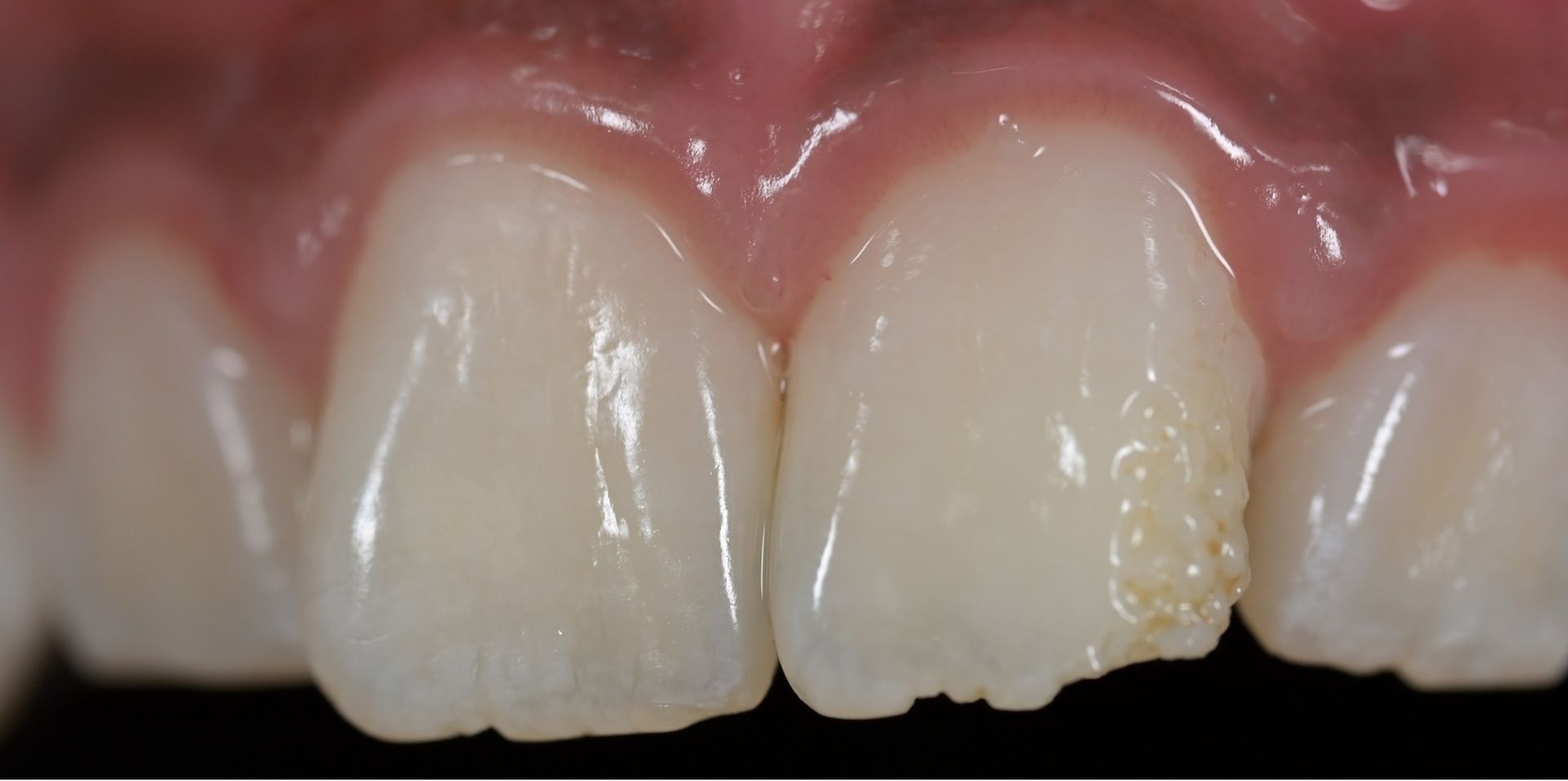 Close-up of human teeth, showing a slight discoloration on one tooth.