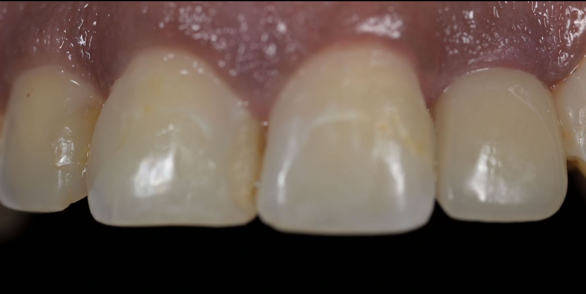 Close-up of front teeth showing their shape, color, and texture.