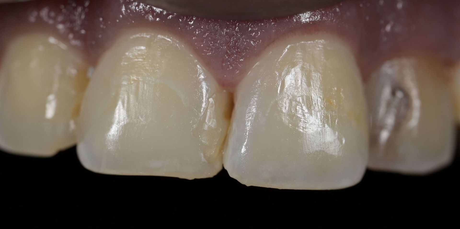 Close-up of teeth, focus on the two central incisors. They are white and have a glossy appearance.