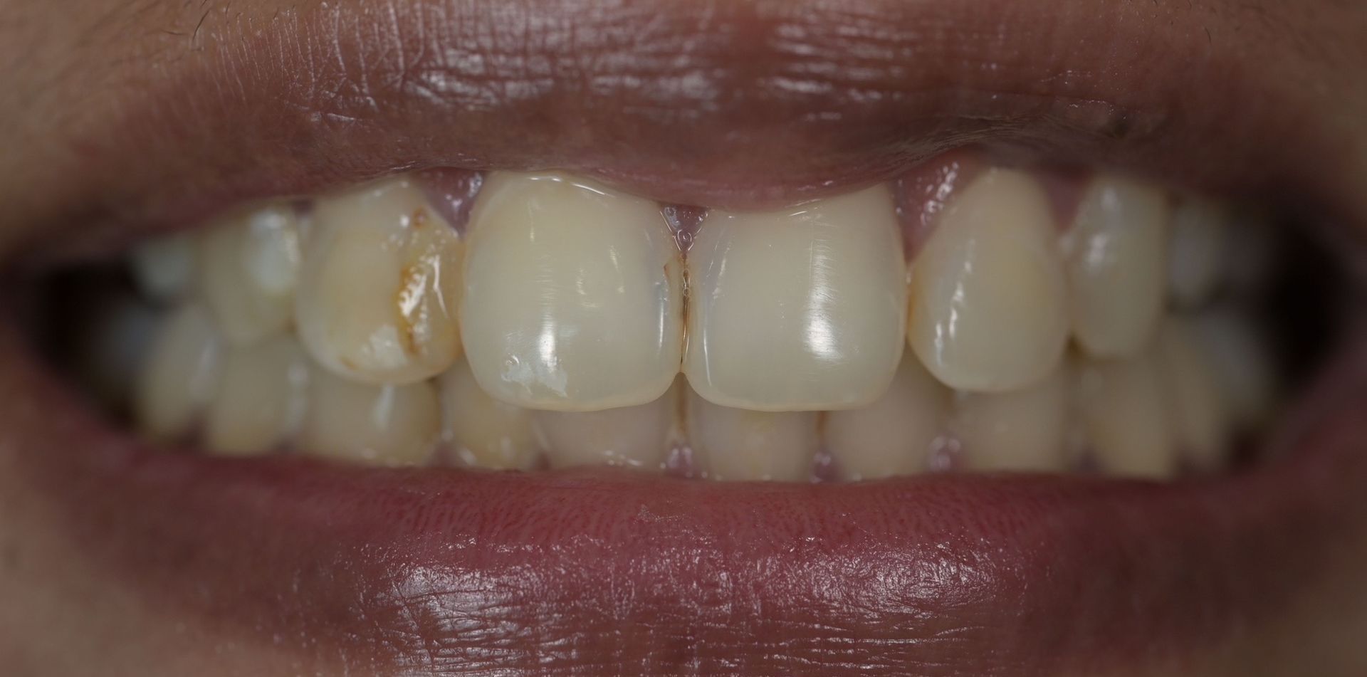 Close-up of a person's teeth, showing a slight discoloration of one tooth and visible lips.
