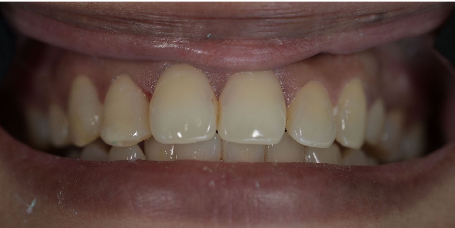 Close-up of human teeth, showing a row of upper teeth with visible gums and lips.