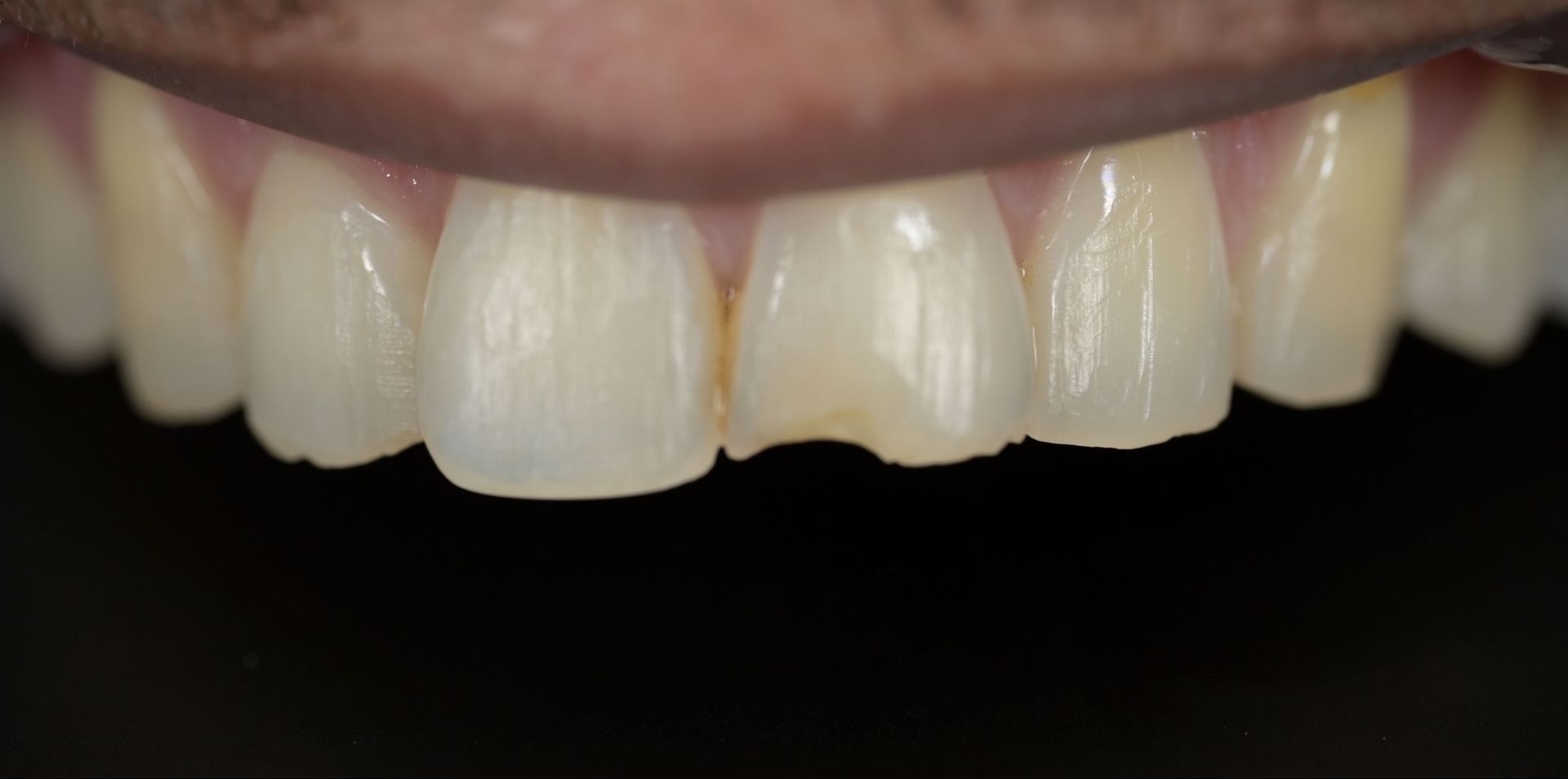 Close-up of teeth, center tooth chipped and discolored. Other teeth are white with visible vertical lines. Black background.