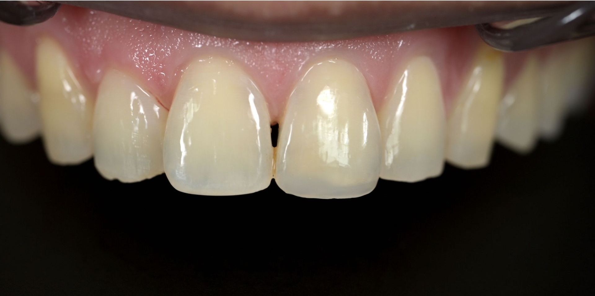Close-up of teeth. The front teeth are light-colored and appear to be well-maintained, with a pink gum line.