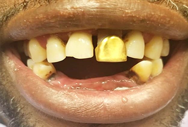 Close-up of a person's mouth with several discolored teeth, including one gold tooth.