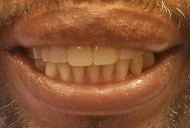 Close-up of a person's smiling mouth showing teeth. The teeth are yellow-tinted and the lips and skin are visible.