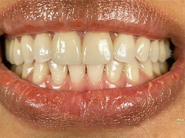 Close-up of a person's smiling mouth showing aligned, white teeth and pink gums.