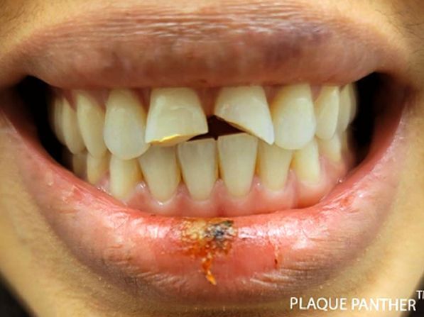 Close-up of a person's mouth with a chipped front tooth and a sore on the lip.