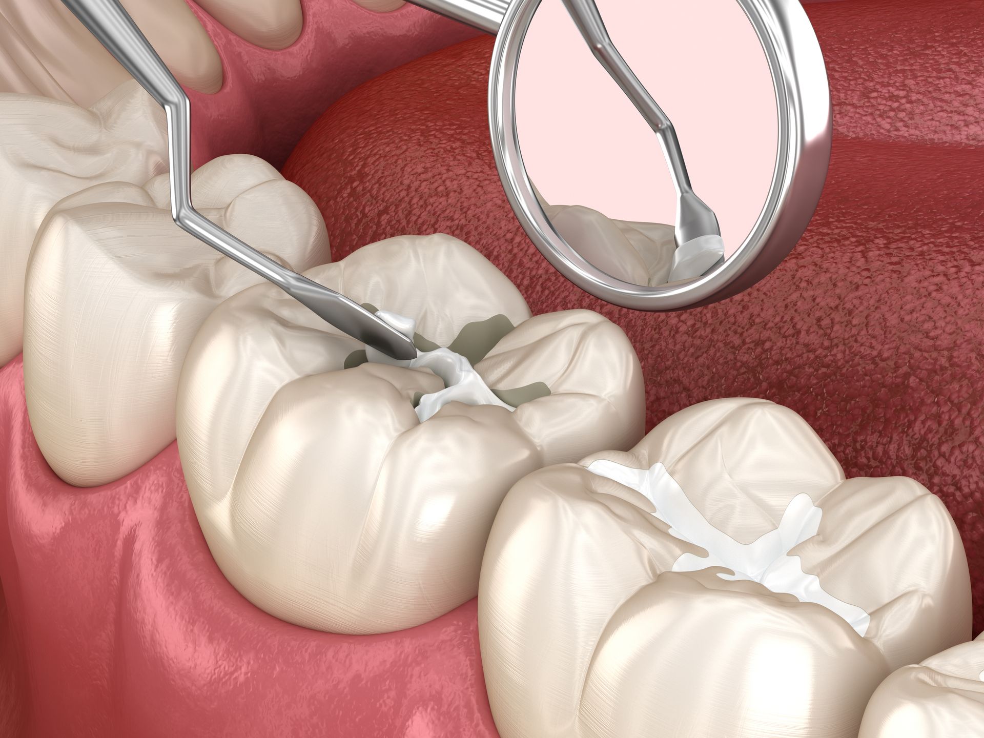 Dental tools in mouth, filling cavity in tooth with white composite material.