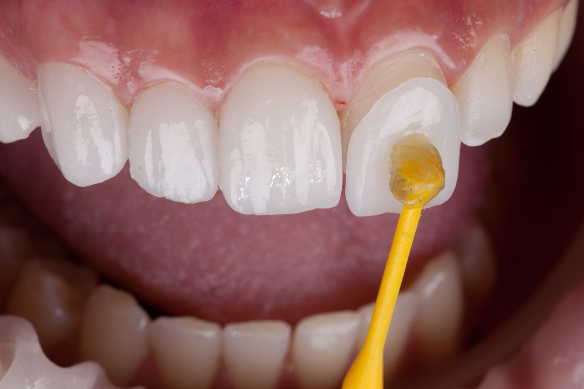 A dentist's hand applying a substance with a yellow applicator to a tooth with a veneer, in a person's mouth.