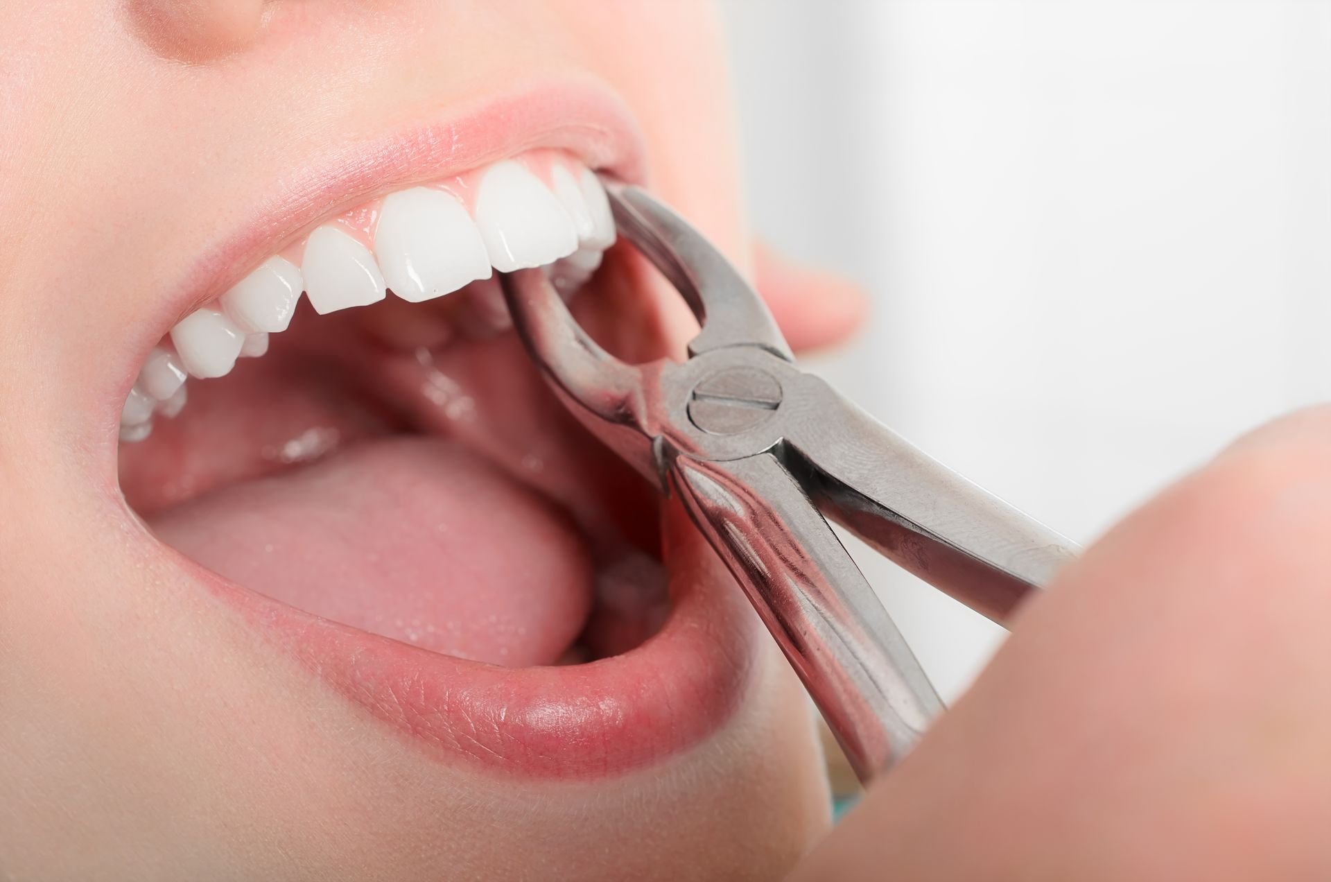 Dental pliers extracting a tooth from a person's open mouth.
