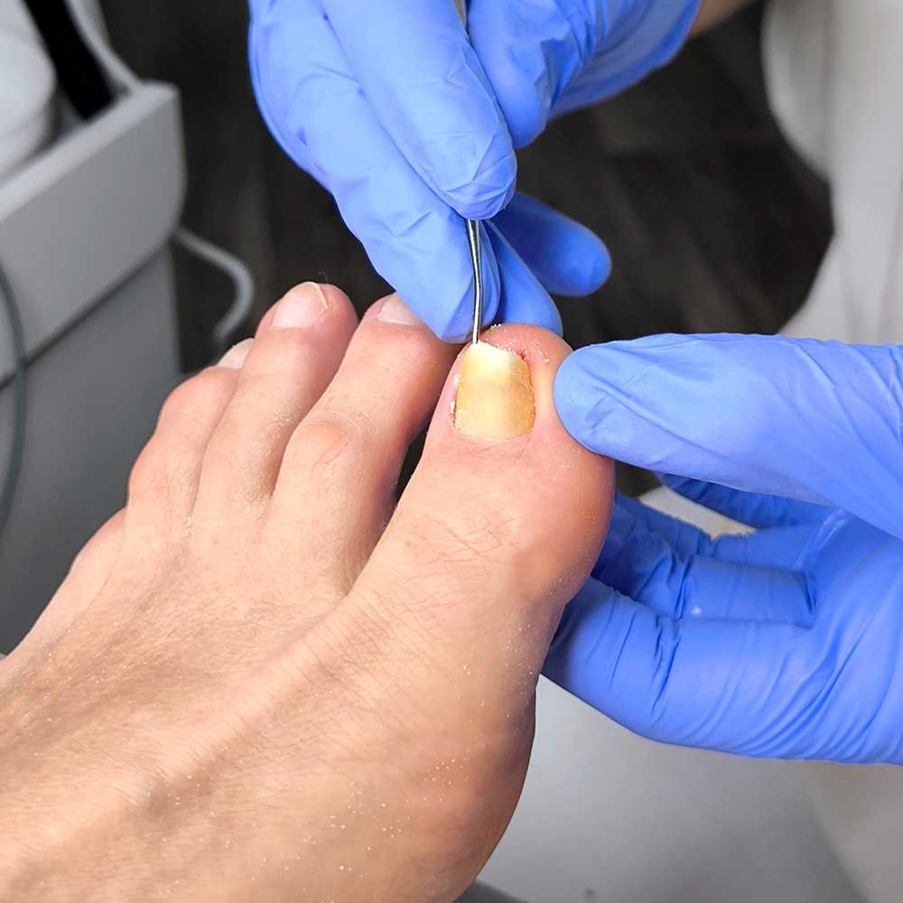 A master podiatrist offering ingrown toenail removal service