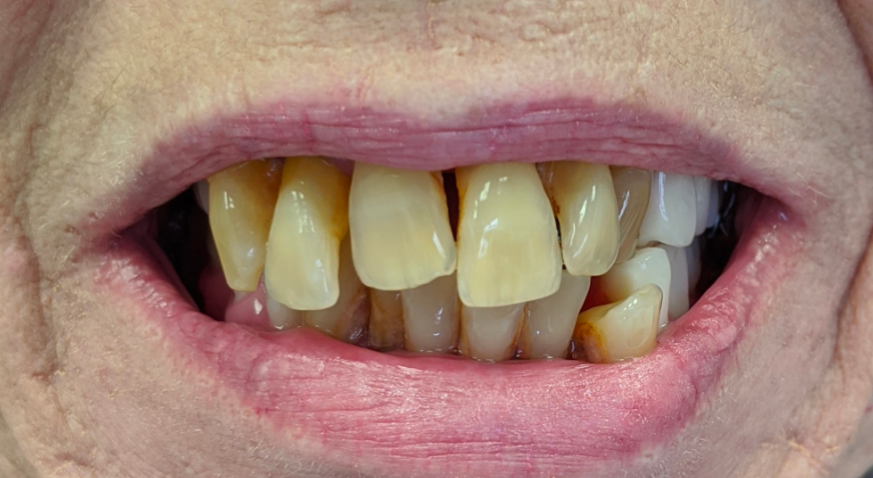 Close-up of a person's teeth, showing yellowed and misaligned teeth within the open mouth. Pink lips.