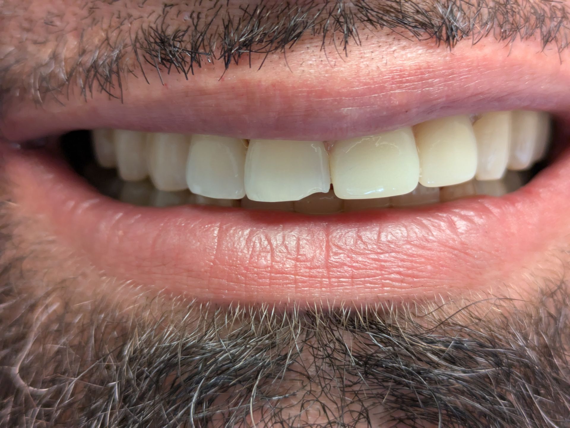 Close-up of a person's smiling mouth. Front tooth chipped, revealing teeth with a creamy white color.