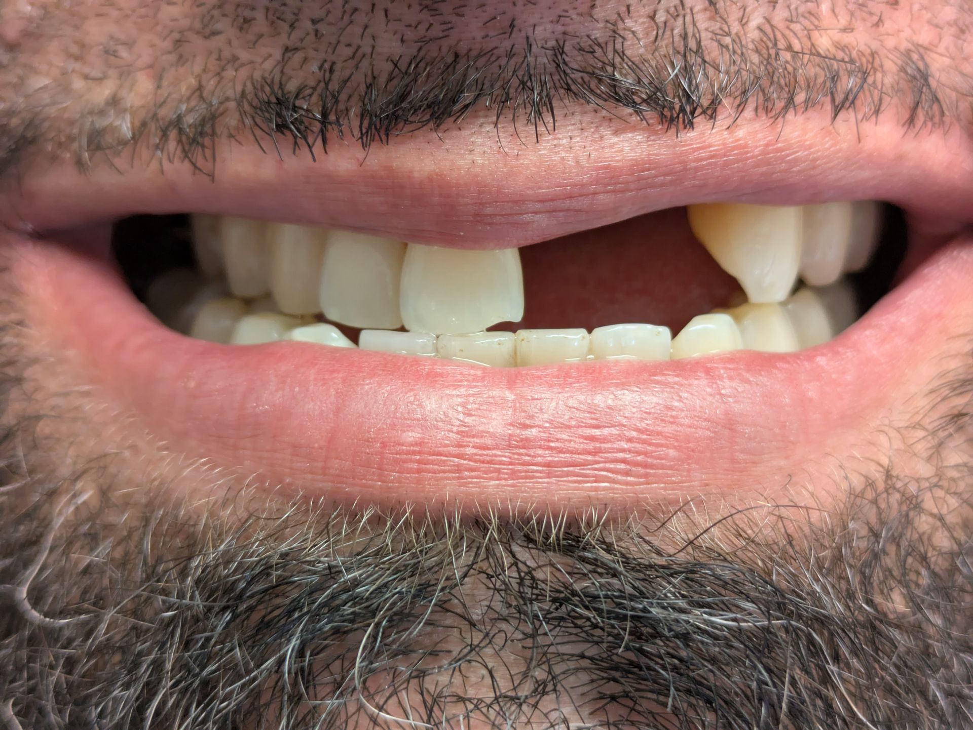 Man smiling, missing one front tooth.  Beard visible, teeth are white.