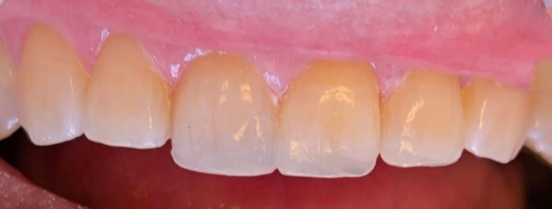 Close-up of teeth and gums. Teeth are light in color, gums are pink.