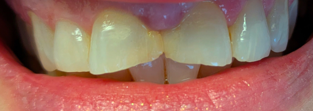 Close-up of a person's teeth, showing yellowed and misaligned teeth within the open mouth. Pink lips.