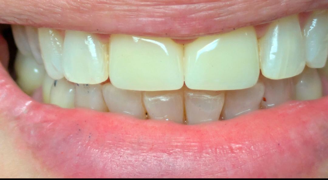 Close-up of a smiling mouth with bright white teeth and pink lipstick.