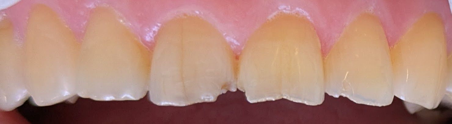 Close-up of a person's upper front teeth, showing chipped and discolored enamel, and healthy gums.