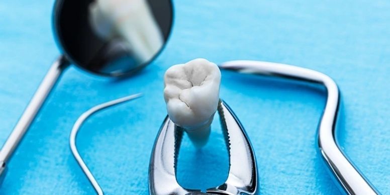 Tooth Extractions