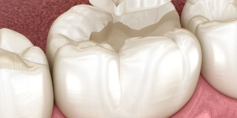 Sealants