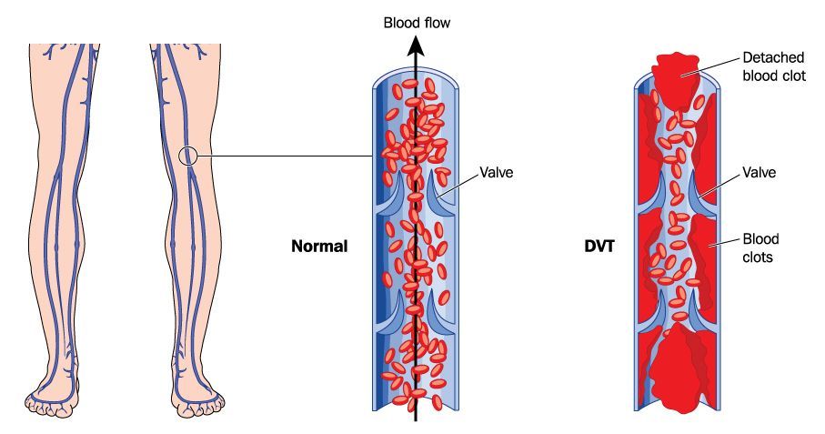 Deep Vein Thrombosis