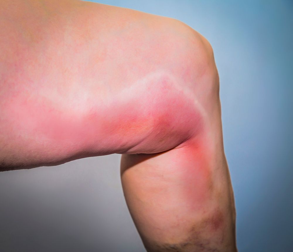 Phlebitis - Vein redness, tenderness