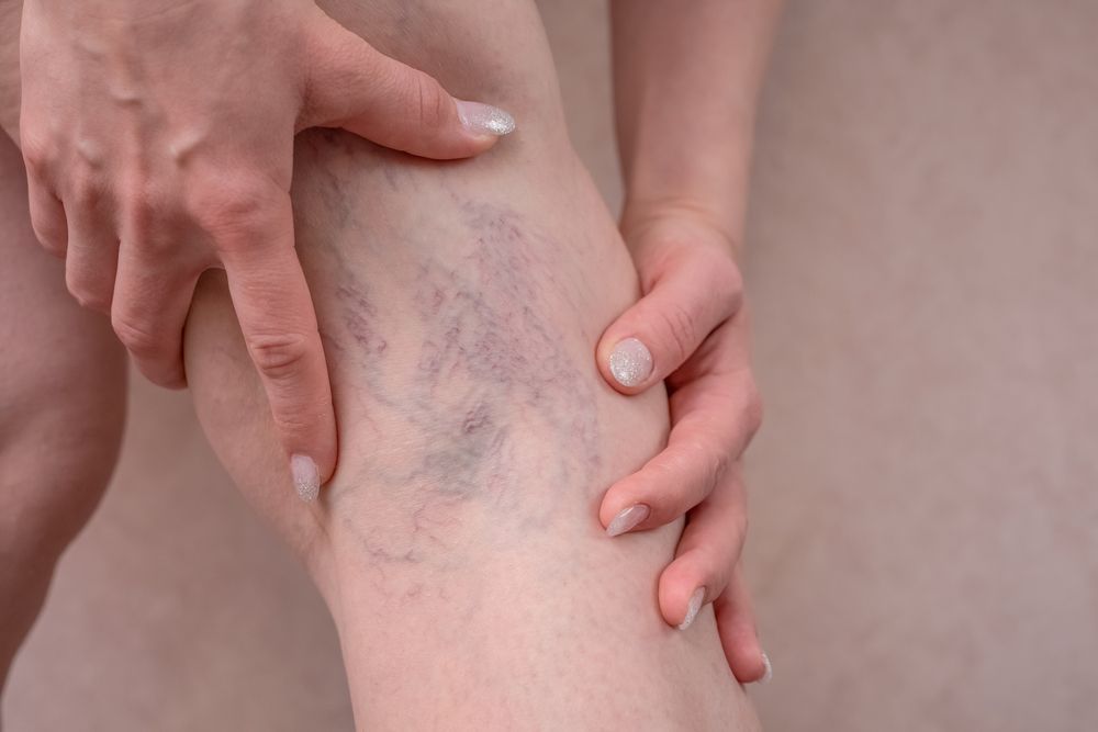 Blood Clots