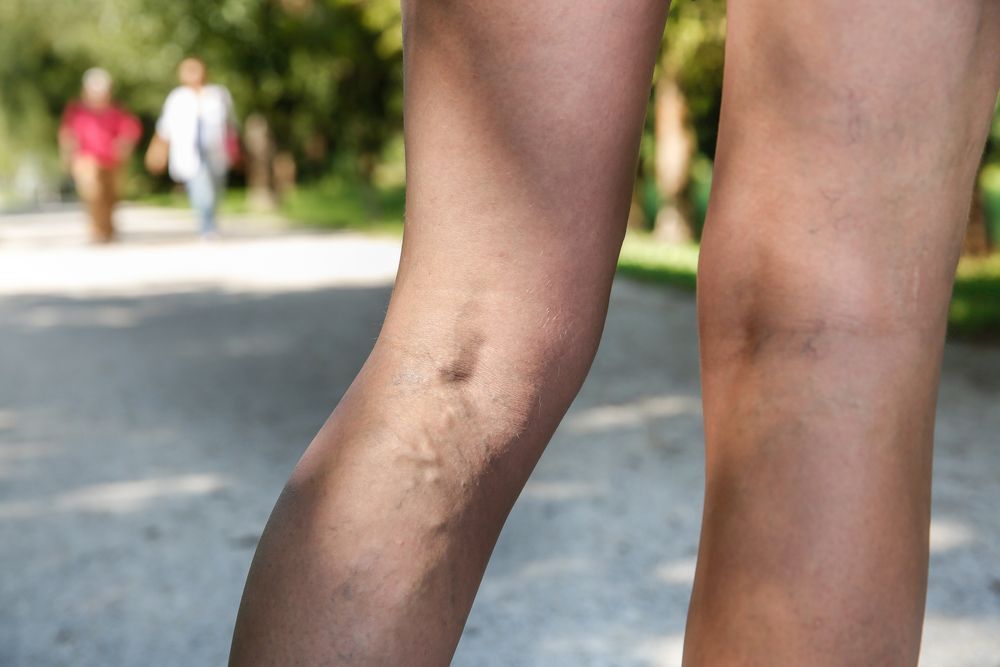 Varicose Veins