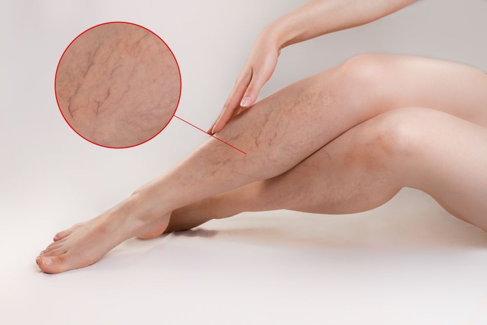 Varicose veins