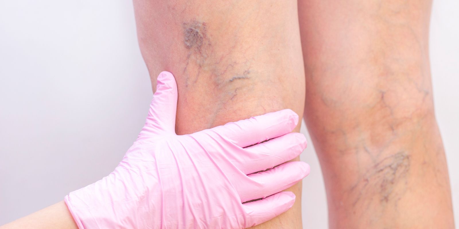 vein doctor performing varicose veins exam