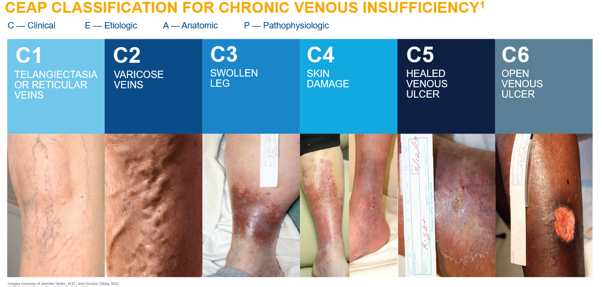 Vein disease progression