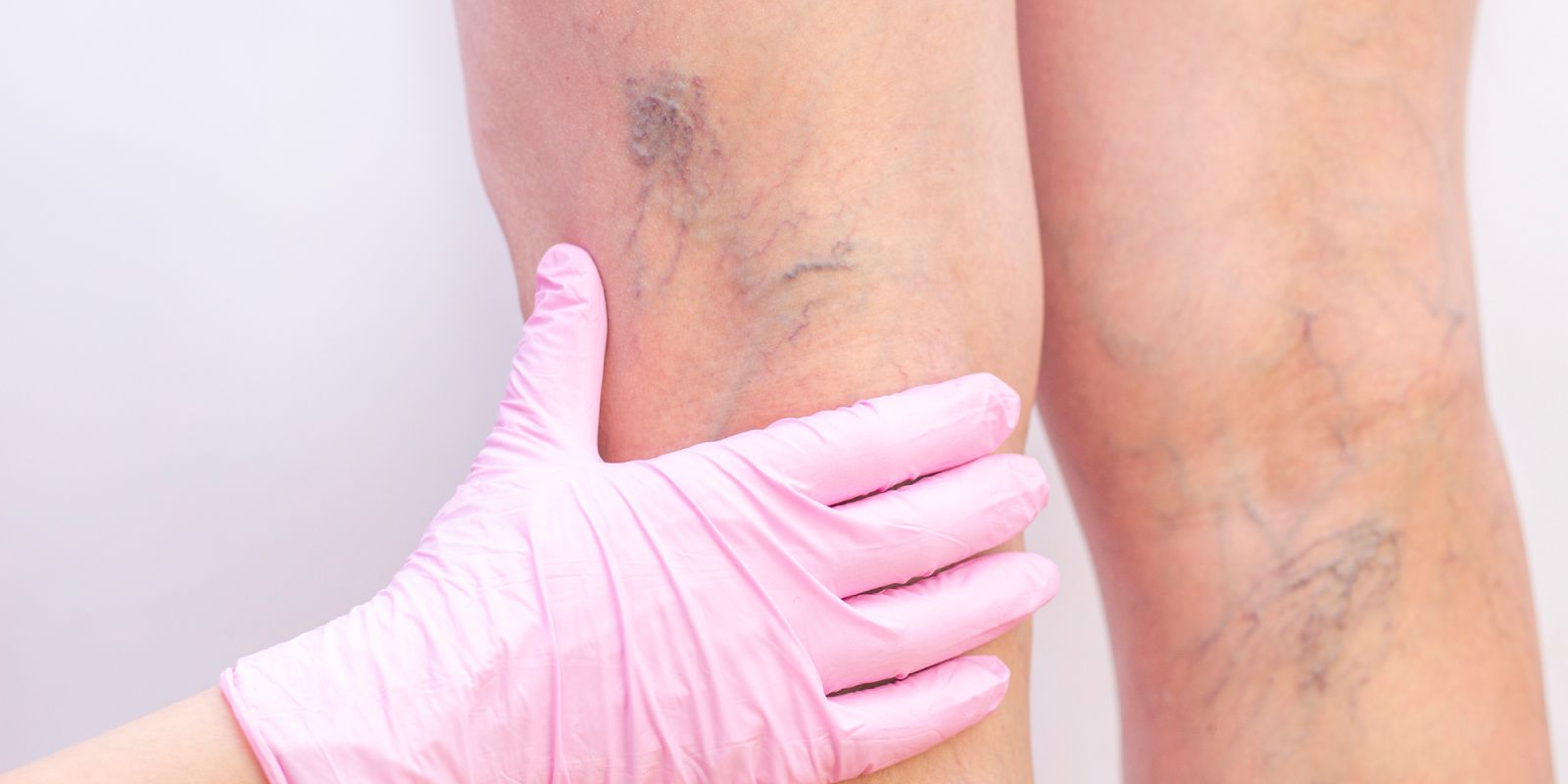 Varicose Veins Causes, Symptoms, Treatments, Prevention & Management