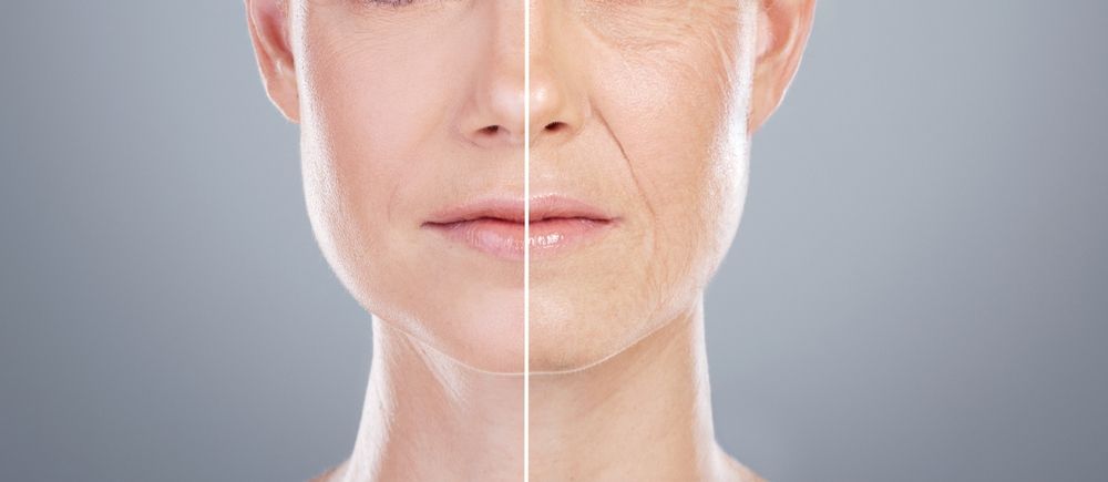 A before and after picture of a woman 's face with wrinkles.