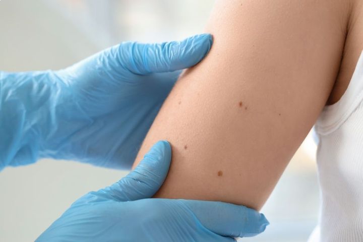 Detecting Skin Cancer 