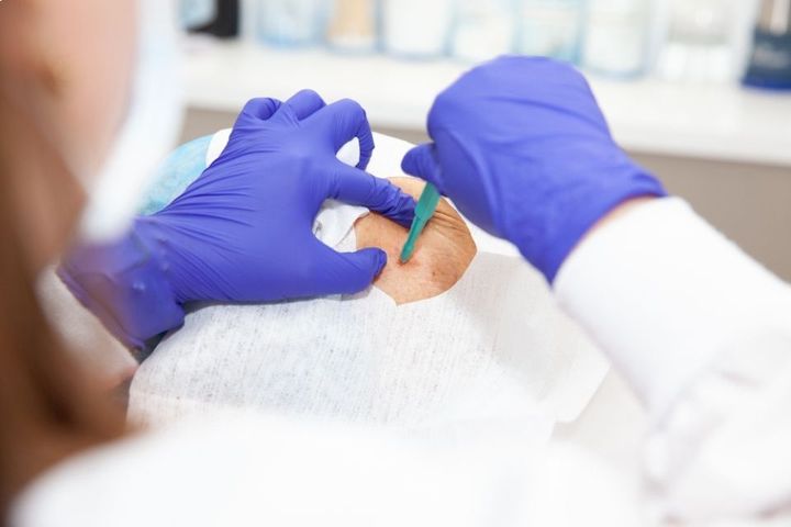 Skin Cancer diagnosis