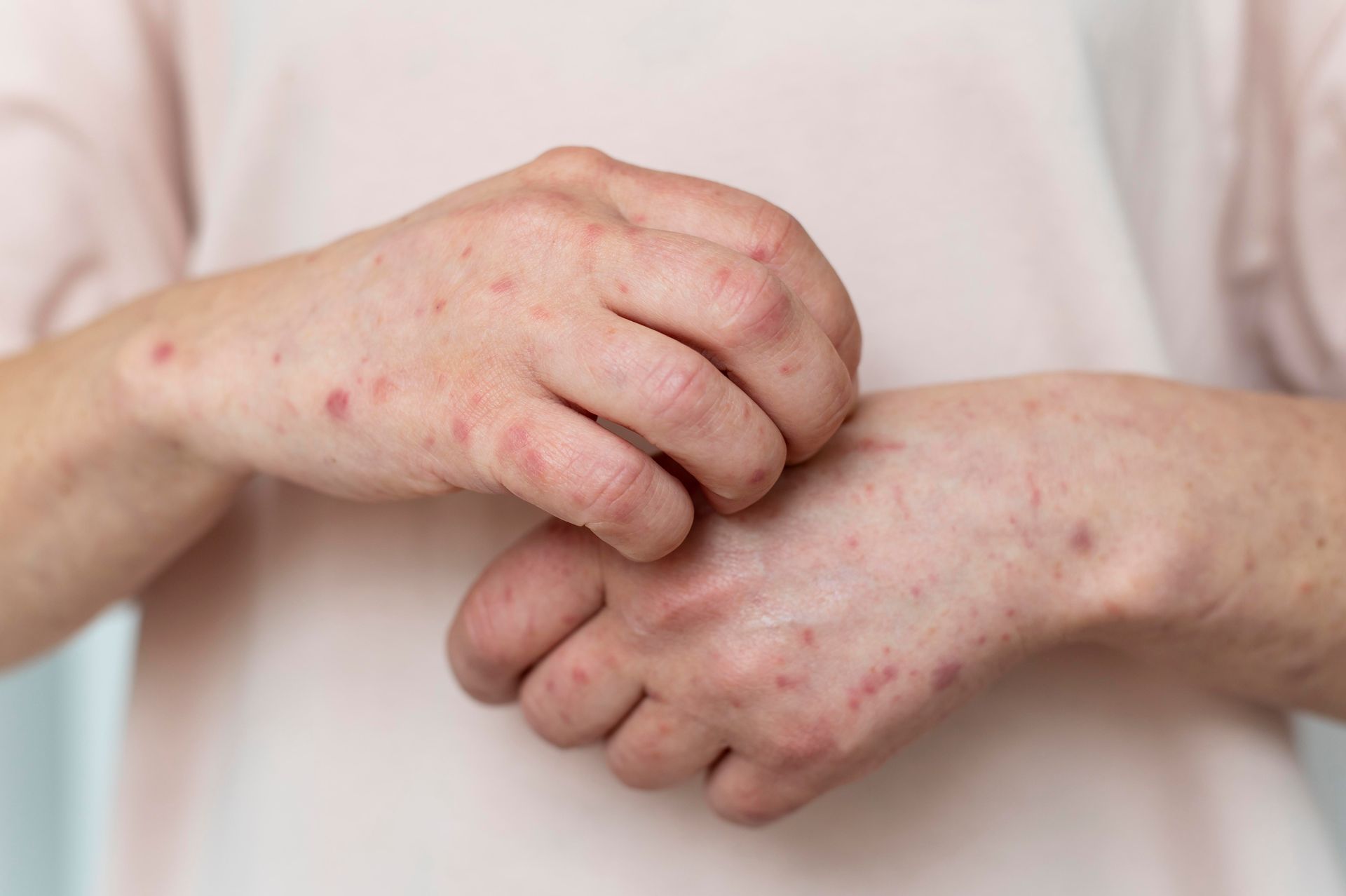 Close-up of hands with red, itchy rash on pale skin, suggesting a skin irritation or allergy.