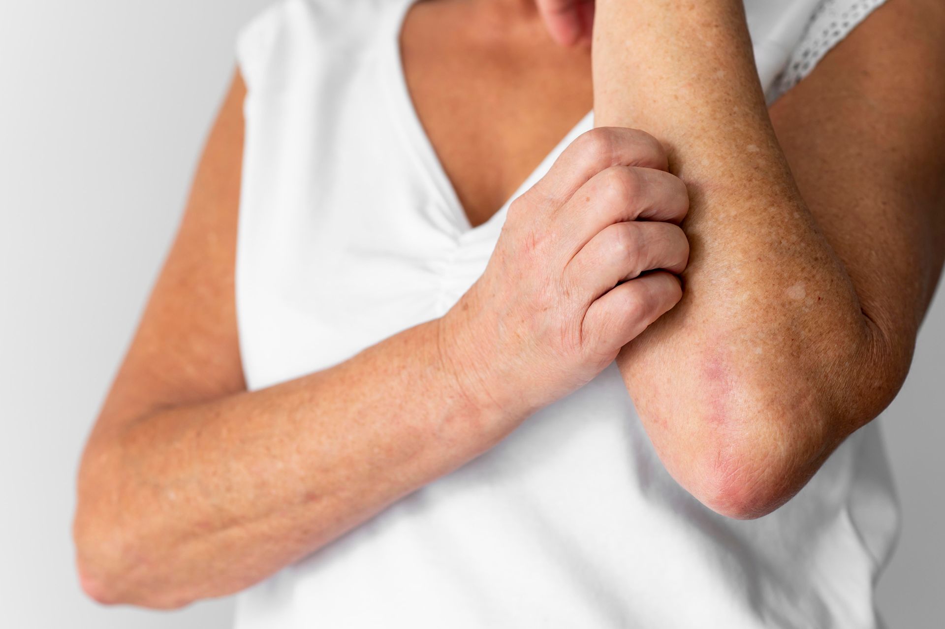 Person scratching an itchy red elbow on a white shirt