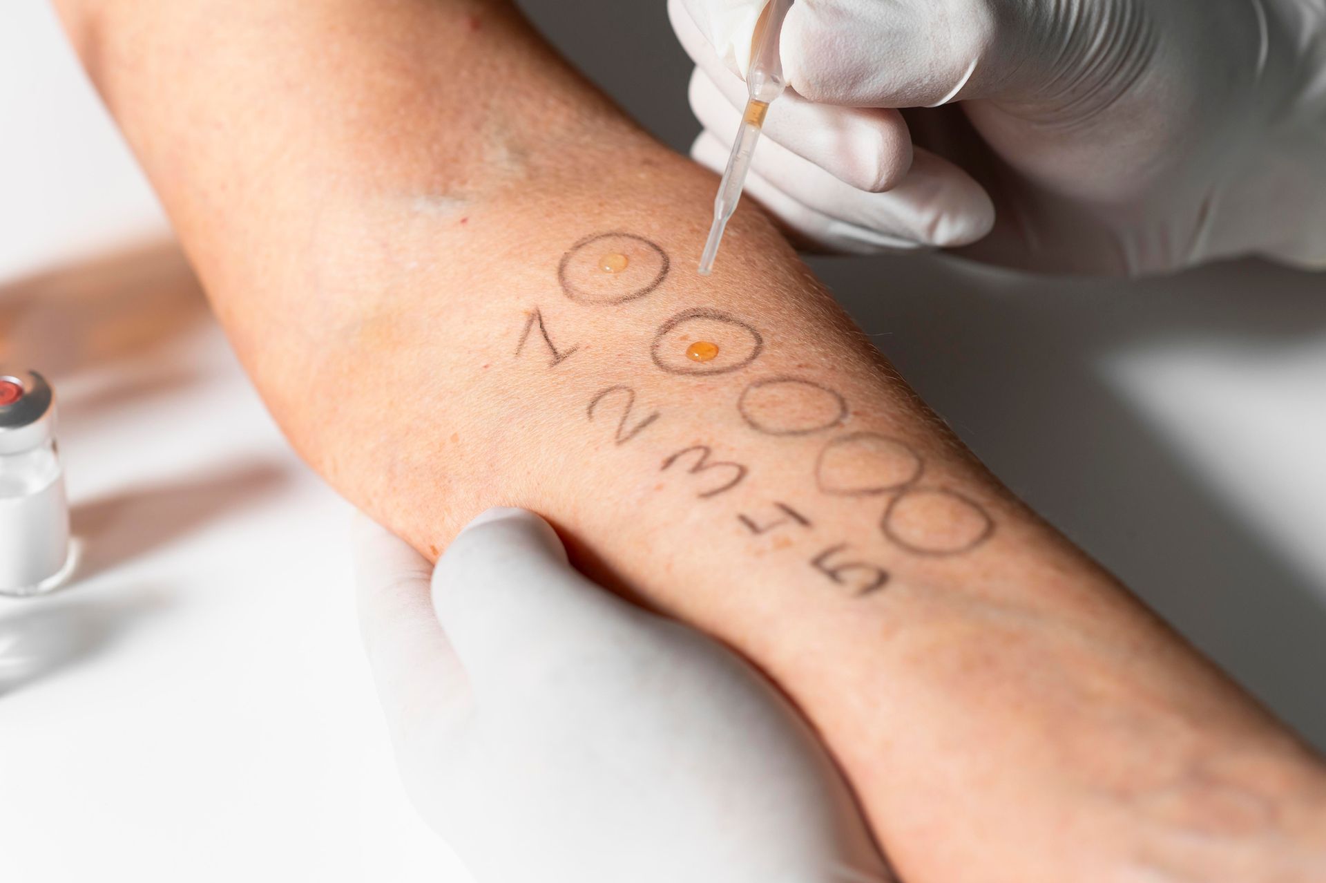 Gloved hands marking a forearm with circles and numbers during a skin treatment procedure